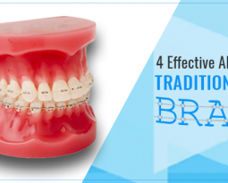 4 Effective Alternatives to Traditional Metal Braces