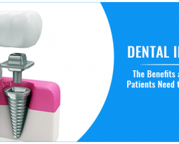 Dental Implants – The Benefits and Aftercare Patients Need to Keep in Mind