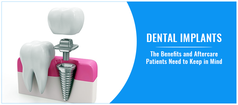 Dental Implants – The Benefits and Aftercare Patients Need to Keep in Mind