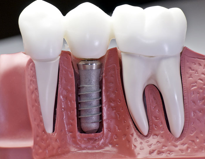 Dental Implants http://www.atlasparkdental.com/gallery/implant.jpg