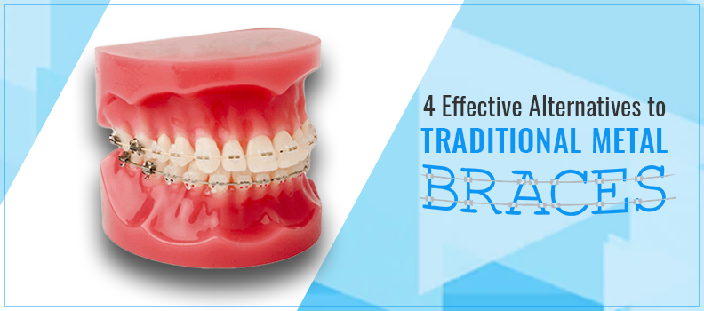 4 Effective Alternatives to Traditional Metal Braces